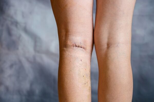 leg vein after surgery for varicose veins