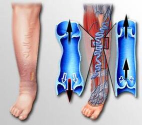blood flow to the legs with varicose veins
