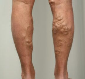 joints in the leg with varicose veins