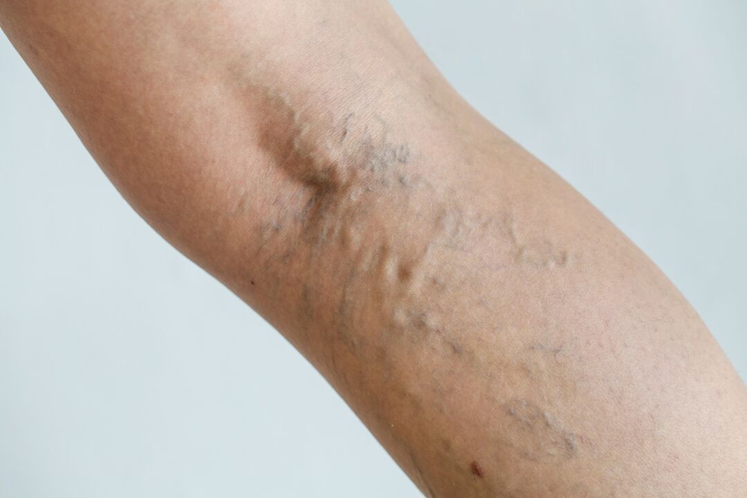 varicose veins in the photo of the leg 1