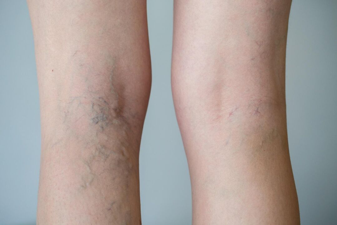 varicose veins in the photo of the leg 2