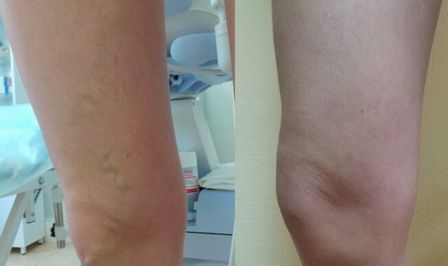 leg before and after treatment of veins with reticular varicose veins