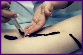 Procedure for the treatment of varicose veins with caterpillars (hirudotherapy)