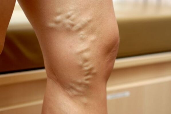 varicose veins in the legs with varicose veins of the small pelvis