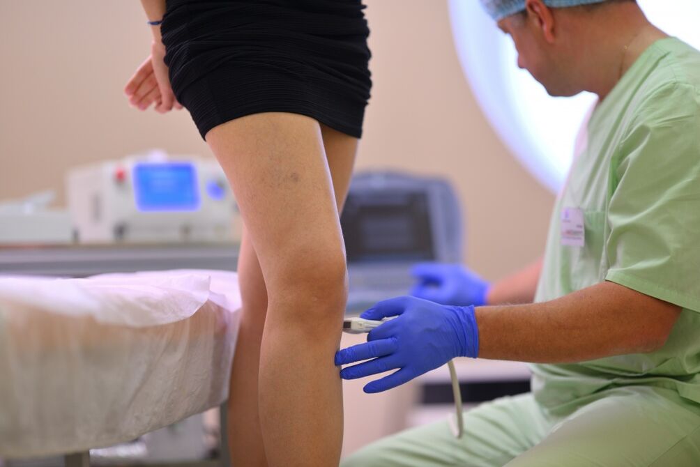 treatment of varicose veins in the legs