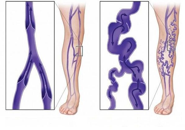 normal venous valves and varicose vein valves