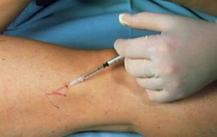 as a treatment of varicose veins in the legs