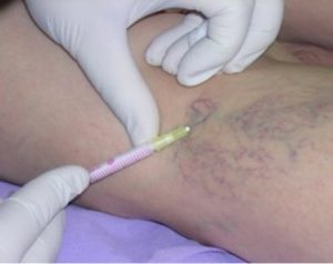 pain with varicose veins treatment of fluids