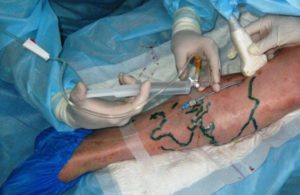 how to get rid of varicose veins, surgery